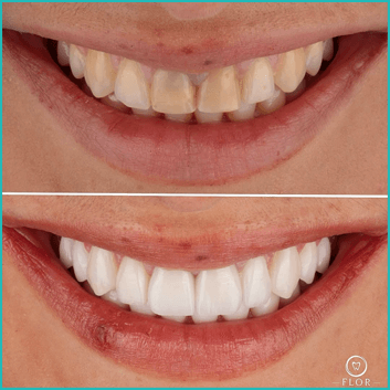 Before and after porcelain veneer treatment comparison